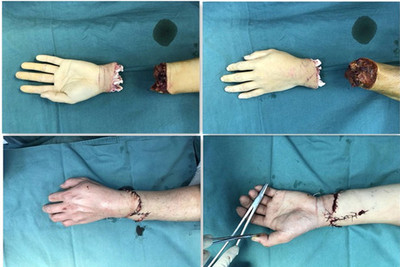 手外科断掌再植术